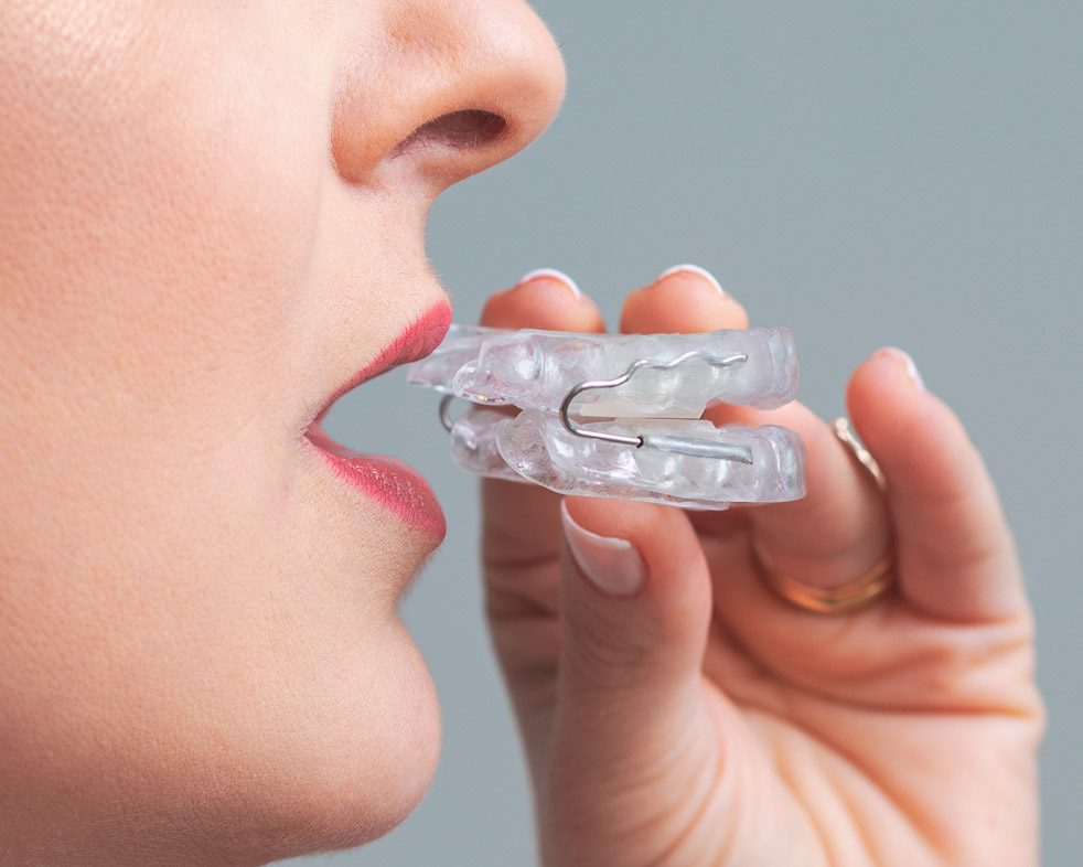 Pessoa posicionando um aparelho intraoral para o sono